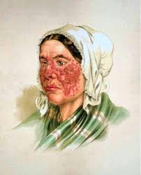 Lupus en la piel: cómo identificarlo, qué esperar y qué cuidados funcionan
