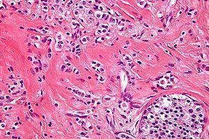 Carcinoma: qué es, tipos comunes y dónde encaja la cúrcuma con prudencia